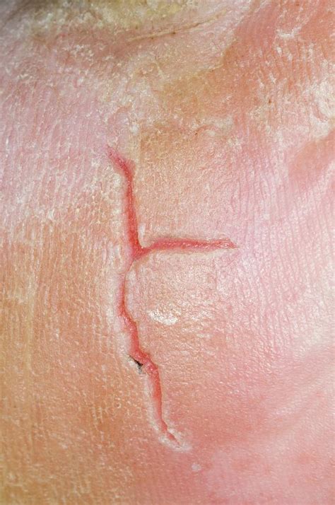 Skin Fissure From Eczema On The Heel Photograph by Dr P. Marazzi/science Photo Library