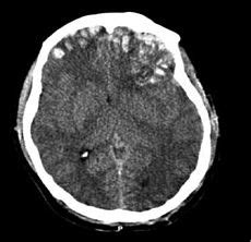 Concussion Brain MRI's, CT scans, and EEG - Concussion Clinic