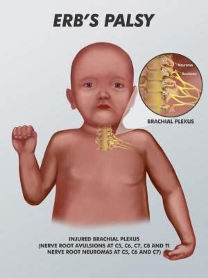 ERP'S PALSY | Erb palsy, Brachial, Plexus products