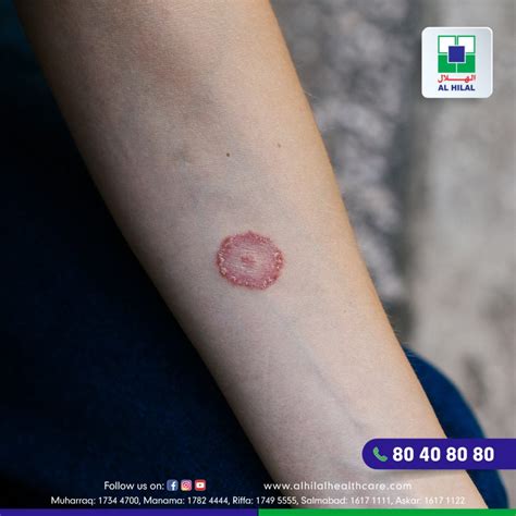 Ringworm: Symptoms, Diagnosis, Treatment, and Prevention