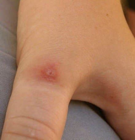 Pictures, Symptoms, and Treatment of Black Widow Spider Bites - HubPages