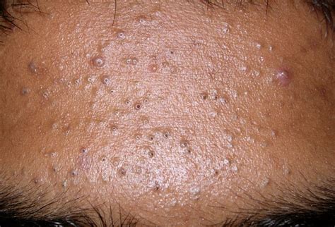 Blackheads - Causes, Treatment and How To Get Rid of Blackheads