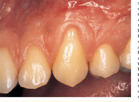 Mucogingival Junction | Semantic Scholar