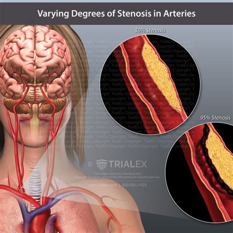 Varying Degrees of Stenosis in Arteries - TrialExhibits Inc.