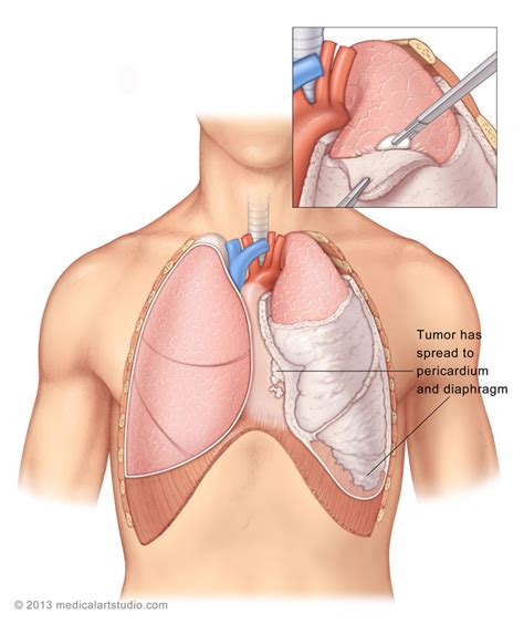 Pleurectomy Decortication Is Effective Handling For Mesothelioma Cancer - Mesothelioma