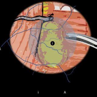 Scheme of Nerve Injury. (1) Nerve bundle that can be injured in its ...