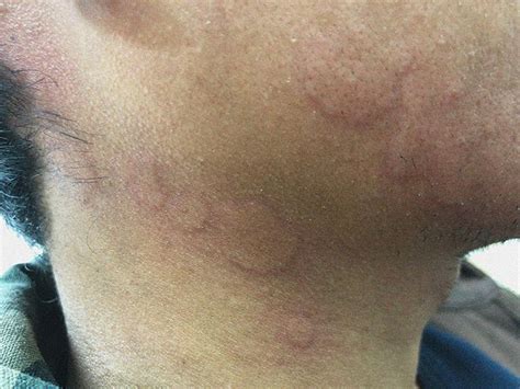 Stress rash on face: Identification, causes, and treatments