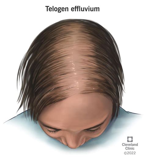 Telogen Effluvium: Symptoms, Causes, Treatment & Regrowth