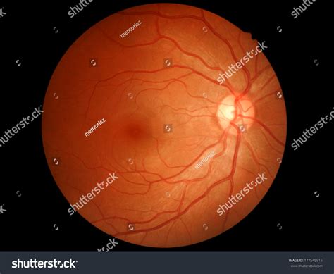 Retina Optic Nerve Normal Right Stock Photo 177545915 | Shutterstock