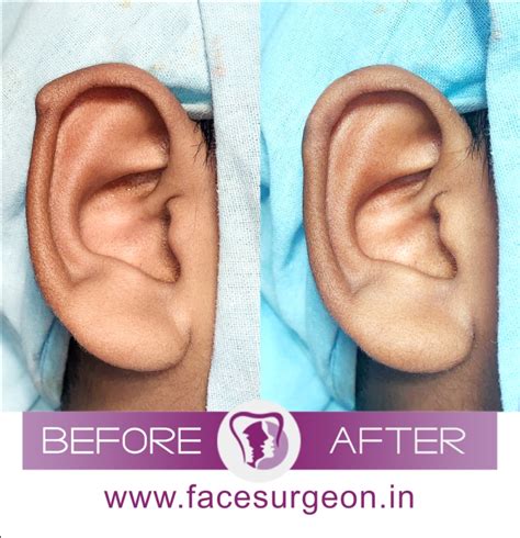 Otoplasty: Know About the Best Cosmetic Ear Surgery in India ...