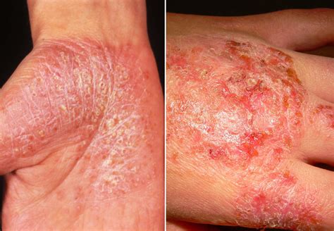 Systematic Review of Eczema in Plaque Psoriasis Treated With Biologic Agents - Dermatology Advisor