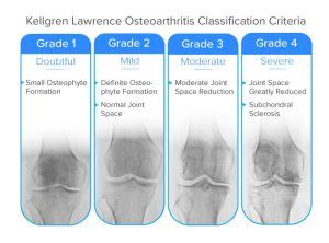 KL-OA-Classification-Diagram - Spring Loaded Technology