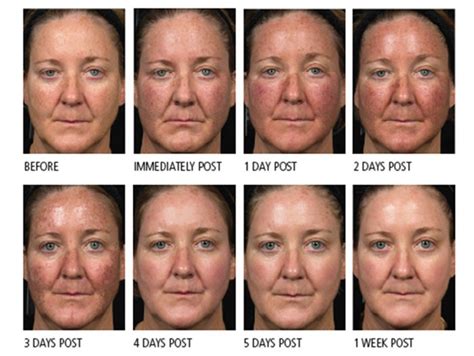 Photodynamic Therapy (PDT) – Dermatology Matters