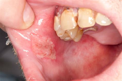 Behcet's syndrome (Behcet's disease) - Dermatology Advisor