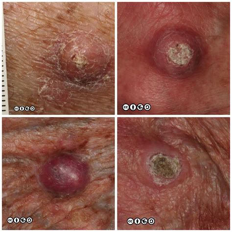 Squamous Cell Skin Cancer Types