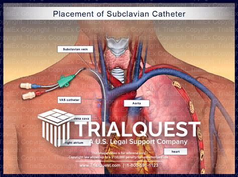 Triple lumen catheter vs picc line - nerystep