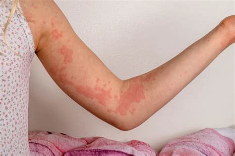 What causes hives and how dangerous can they be? A nurse practitioner ...