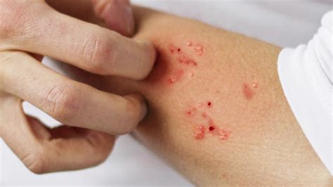 Scabies Rash: Treatment, Symptoms, Bites How To Get Rid, 43% OFF