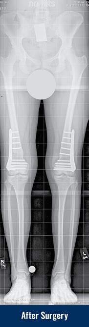 Knock Knees | International Center for Limb Lengthening