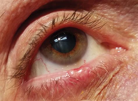 Seborrheic Keratosis Eyelid