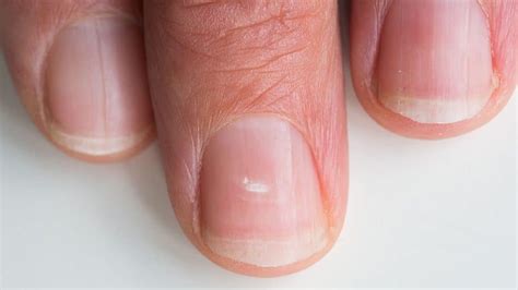 What Causes White Horizontal Lines On Fingernails - Design Talk