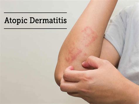 Treatment of Atopic Dermatitis with Natural Herbal Remedies