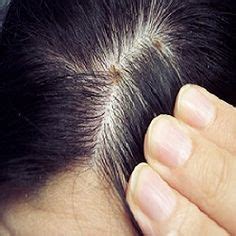 Scabs On Scalp - A Detailed Guide | Hair scalp problems, Scalp treatment diy, Dry scalp remedy