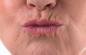 What causes upper lip wrinkles? What is the best cream for wrinkles on upper lip? Find out the ...