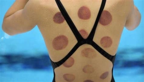 5 Reasons to Try Cupping Therapy - Heal With Acupuncture