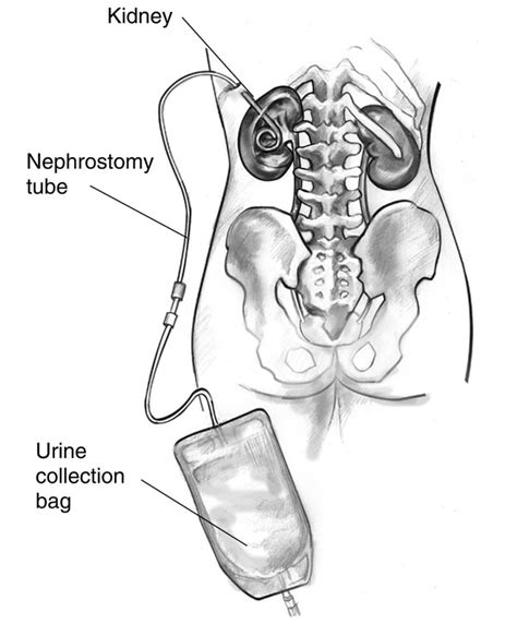 emDOCs.net – Emergency Medicine EducationComplications of Nephrostomy ...