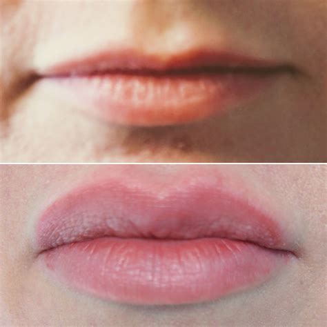 juvederm lips near me - Realistic Log-Book Efecto