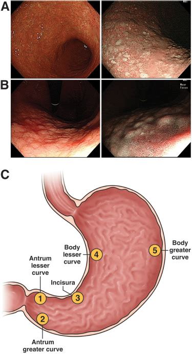 Management of Gastric Intestinal Metaplasia - Clinical Gastroenterology and Hepatology