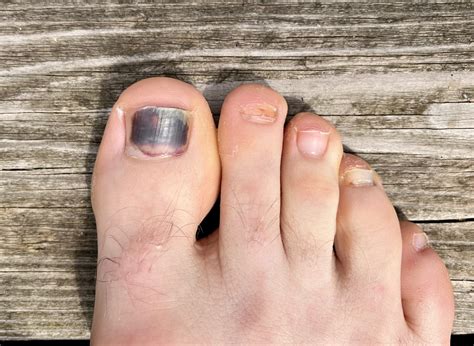Black Toenail: Causes, Treatment, and Prevention Tips - Feet First Clinic