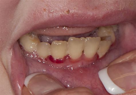 Vitamin C deficiency (Scurvy) - Dermatology Advisor