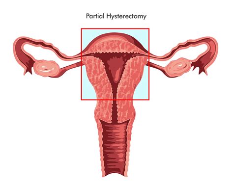 Partial Hysterectomy: What is, Procedure and Recovery Explained ...