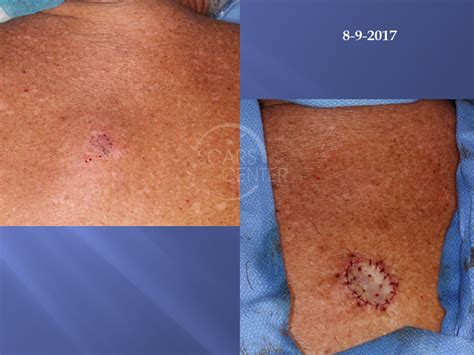 Melanoma Removal