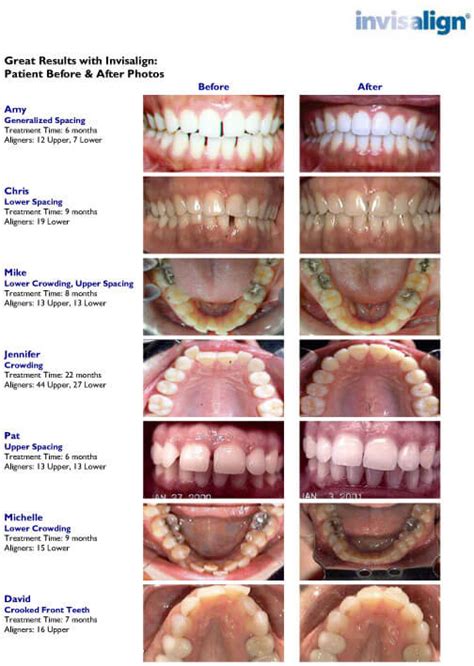 Real Invisalign® Results | Invisalign Provider in Brickell, FL