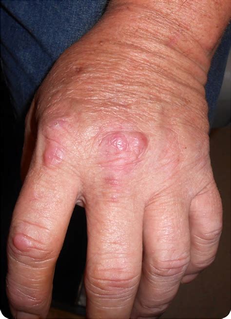 Bumps On Knuckles