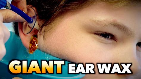 GIANT EAR WAX REMOVAL! | Dr. Paul | Doovi