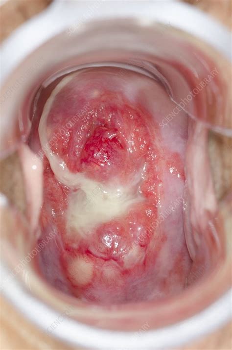 Nabothian cysts of the cervix - Stock Image - C019/4138 - Science Photo Library