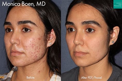 Scar & Acne Scar Treatment | San Diego, CA | CLDerm