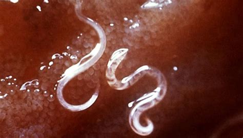 Intestinal worms: Symptoms, causes, risks, types, and treatment