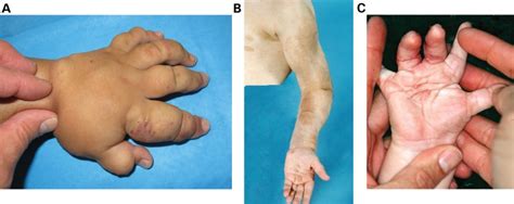 Overgrowth is apparent in disorders distinct from type I macrodactyly.... | Download Scientific ...