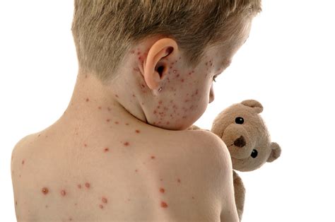 Measles In Children