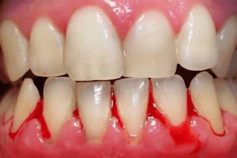 can smoking give you gum disease Teeth disease tobacco smoking gum rotten tooth loss dental bad ...