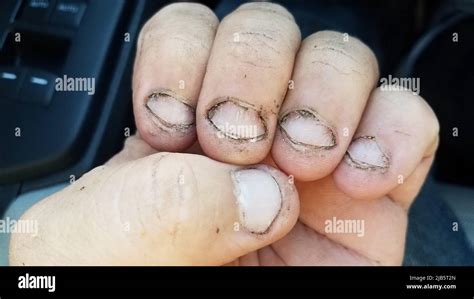 Gross fingernails hi-res stock photography and images - Alamy