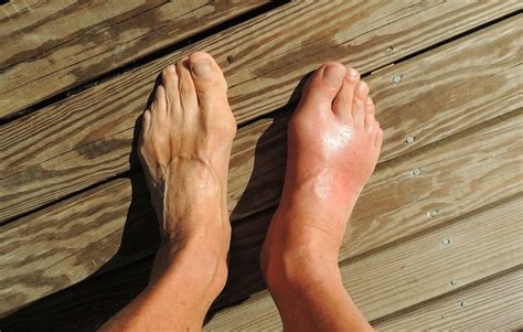 10 Home Remedies For Gout That Help Ease The Pain & Swelling