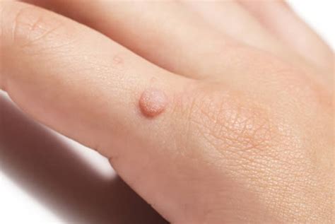 Worried About Warts? - Coast Dermatology & Skin Cancer Center