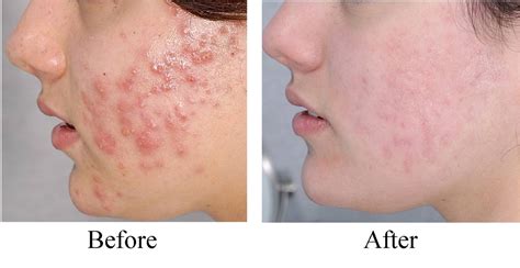 luminesce before and after pictures, used on ache, Visit my site to purchase your 7 day sample ...