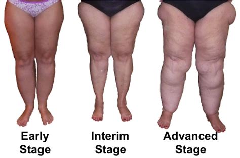 Lipoedema_Stages | DNG Healthwize